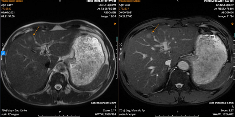 Hình ảnh khối u gan chụp CT