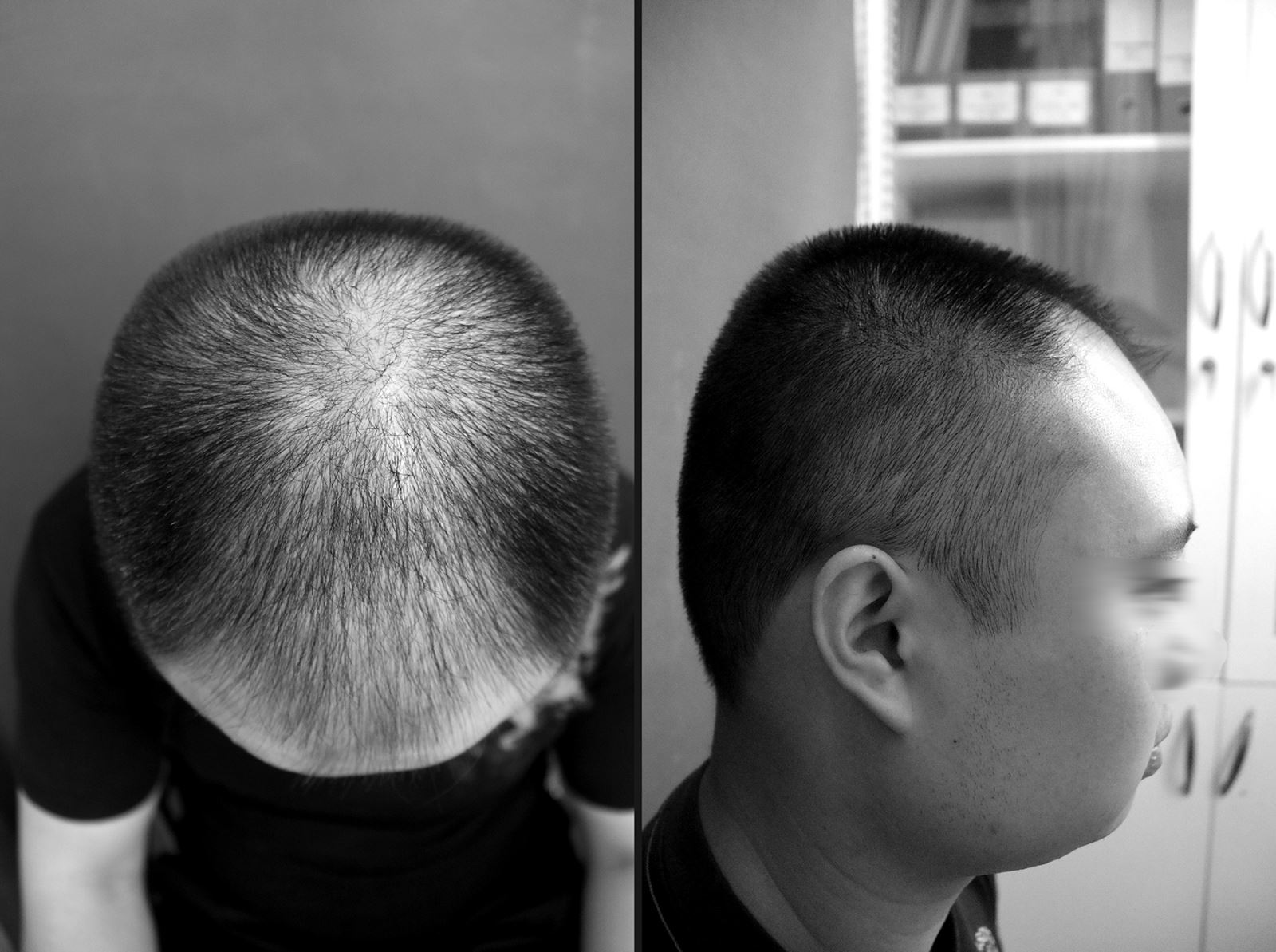 Hình ảnh trước và sai trị liệu rụng tóc bằng phương pháp Meso tại Bệnh viện Da liễu Trung ương. (Ảnh: BSCC)