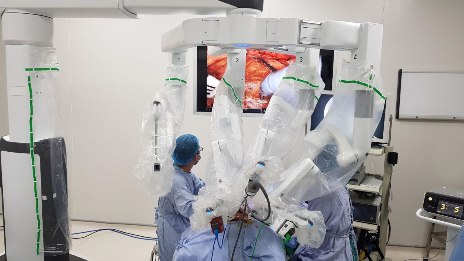 Phương pháp phẫu thuật robot có nhiều ưu điểm vượt trội: đảm bảo thẩm mỹ, sang chấn tối thiểu, không chảy máu, giảm đau tối đa và phục hồi nhanh chóng.