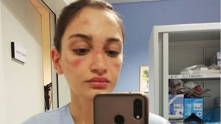 Đeo khẩu trang y tế chặt trong nhiều giờ đồng hồ khiến khuôn mặt nữ y tá tại Italy trầy xước. (Ảnh: Instagram/Alessia Bonari)