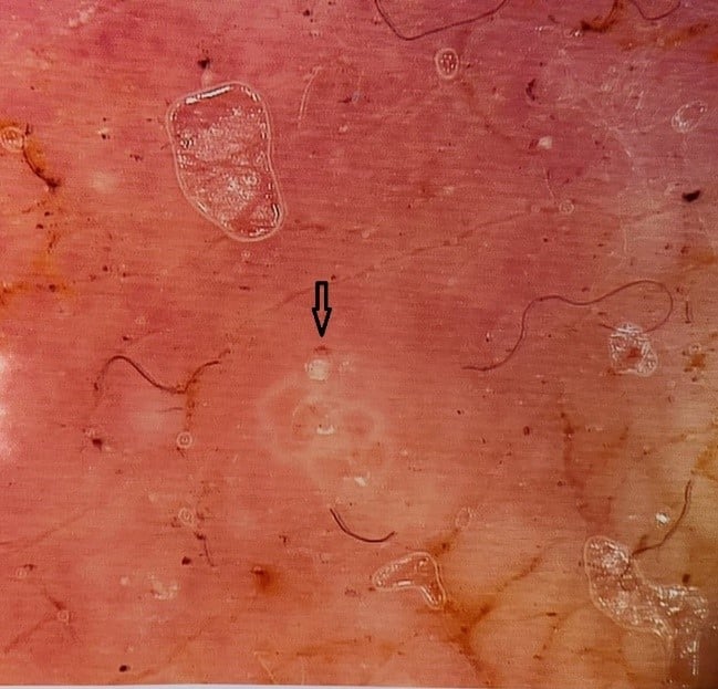 Hình ảnh ký sinh trùng ghẻ trên Dermoscopy.