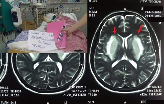 Phim chụp cộng hưởng từ não của một bệnh nhân bị ngộ độc nặng methanol (mũi tên màu đỏ chỉ tổn thương hoại tử nhân bèo hai bên). (Ảnh: BSCC)