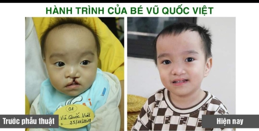 Bé Vũ Quốc Việt ttrước và sau khi được Bệnh viện Việt Nam - Thụy Điển Uông Bí phẫu thuật dị tật bẩm sinh khe hở môi, khe hở vòm miệng.