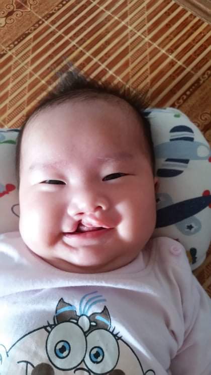 Bé Nguyễn Minh Hằng - con gái chị Lê Thị Kim Hương - trước khi được phẫu thuật vá khe hở môi và đóng vòm.